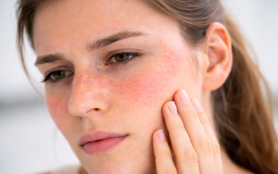 Can You Get Rid of Seb Derm Permanently?